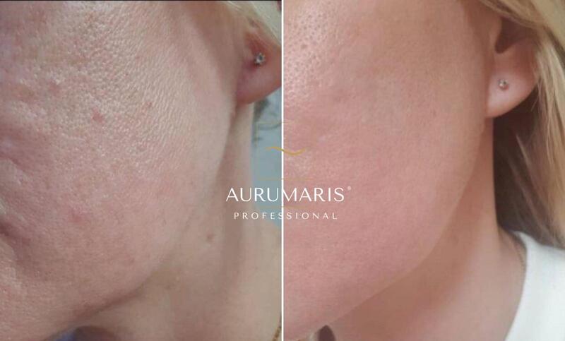 aurumaris-nano-needles-home-set-basic-efekt-zmarszczki