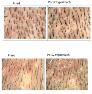 wyniki-badan-regrow-nano-needles-dla-wlosow